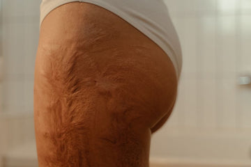How to Fade C Section Scars Permanently?
