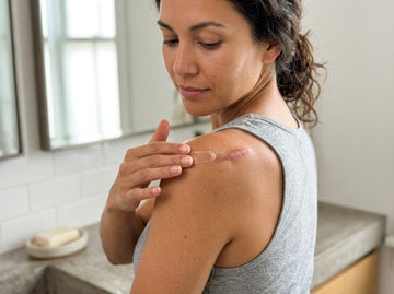 Preventing Keloids After Orthopedic Surgical Incisions